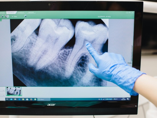 Sensibilità dentale: cause e rimedi efficaci