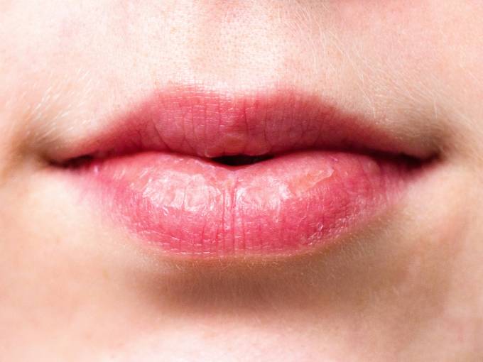 Xerostomia: come la riduzione della saliva influisce sulla salute orale